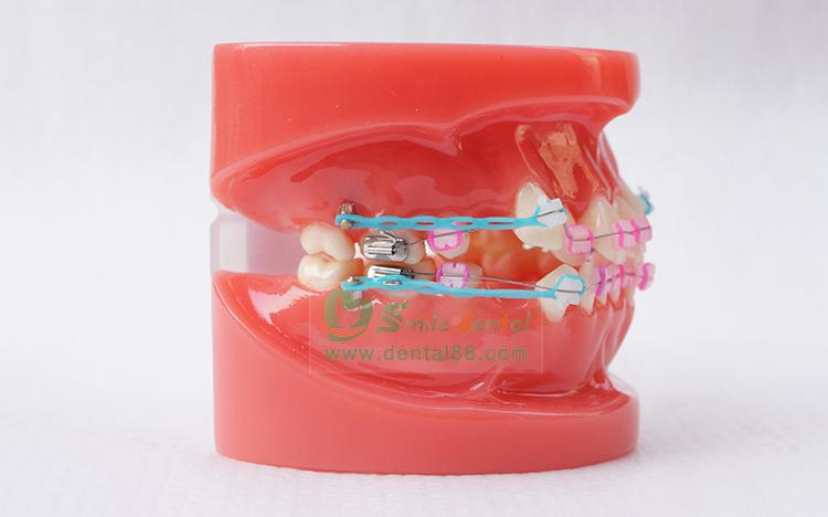 TM-B1-03 Orthodontic Model